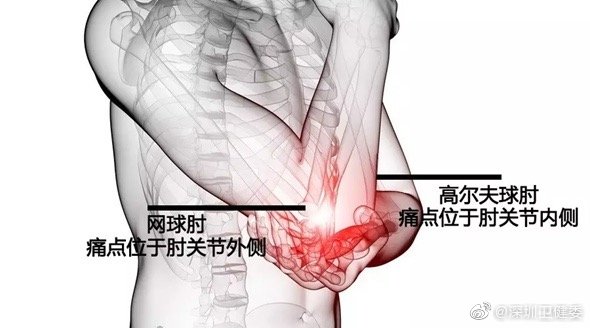 拧毛巾都手疼？你可能患上“家庭主妇肘”