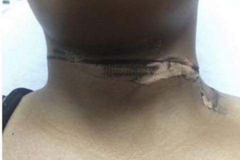 女子颈部被手机充电器烧伤 烧伤程度为二级