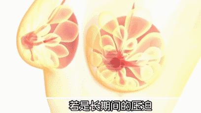 这个动作，让胸部变形又下垂，还会加大患癌风险！贴身内衣这样挑，穿出乳腺健康