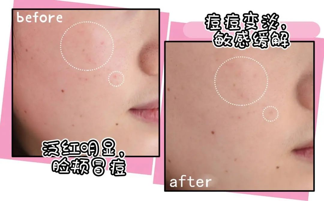 口罩戴出干燥、敏感、痘痘?来康康烂脸女孩都是怎么自救的!