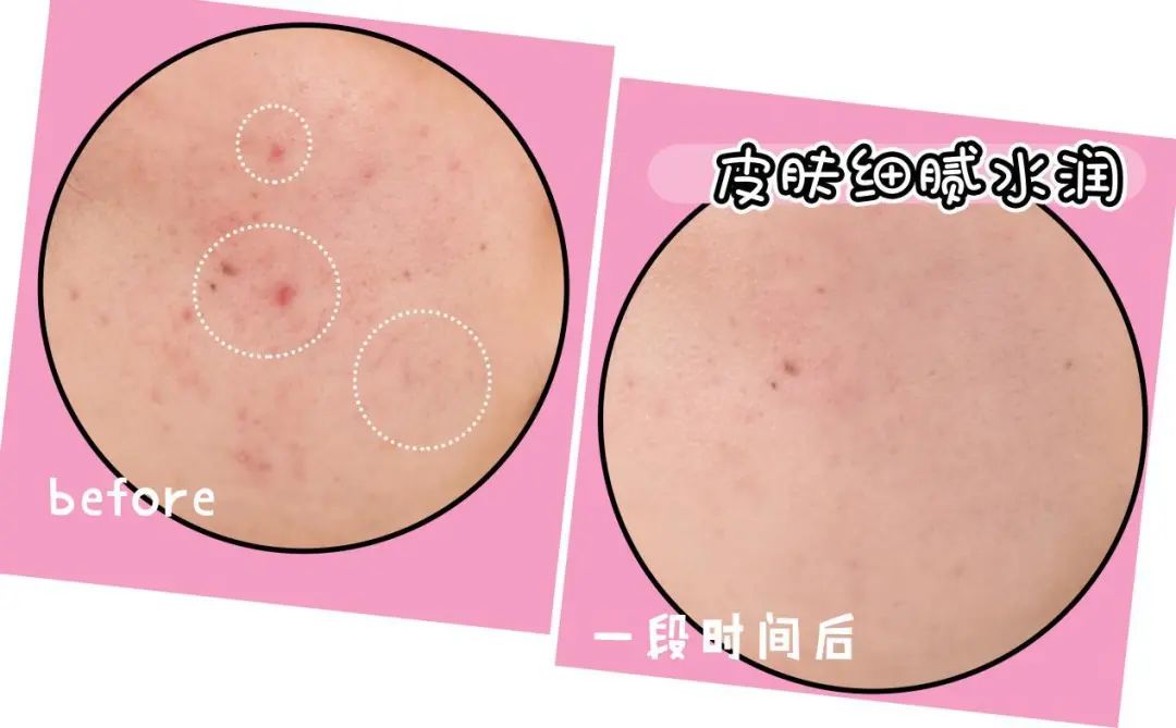 口罩戴出干燥、敏感、痘痘?来康康烂脸女孩都是怎么自救的!