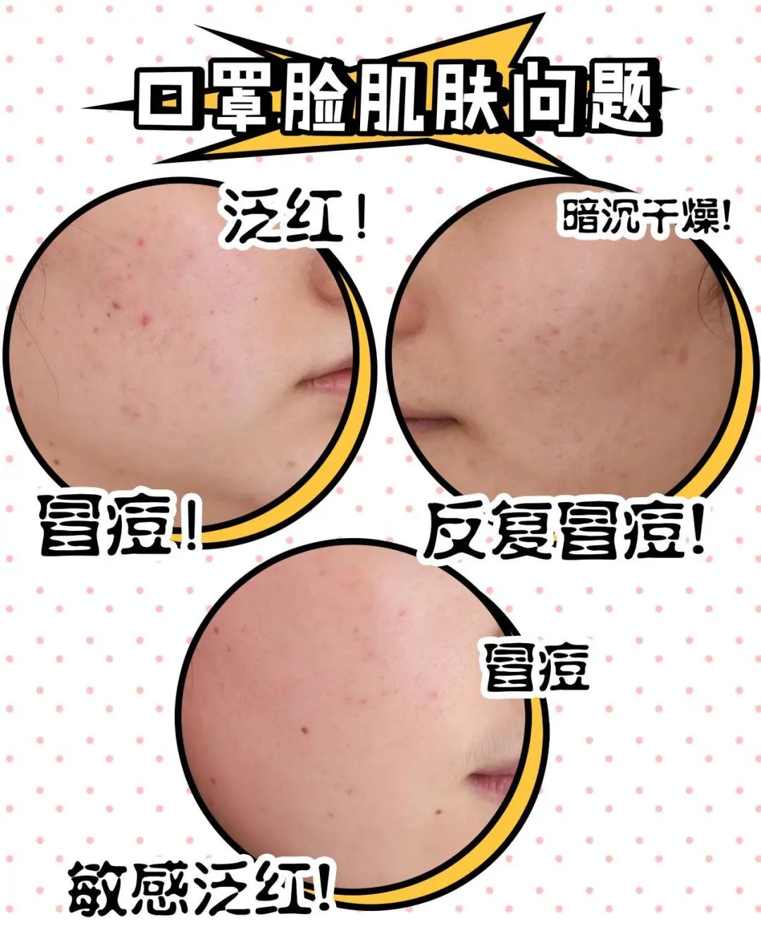 口罩戴出干燥、敏感、痘痘?来康康烂脸女孩都是怎么自救的!