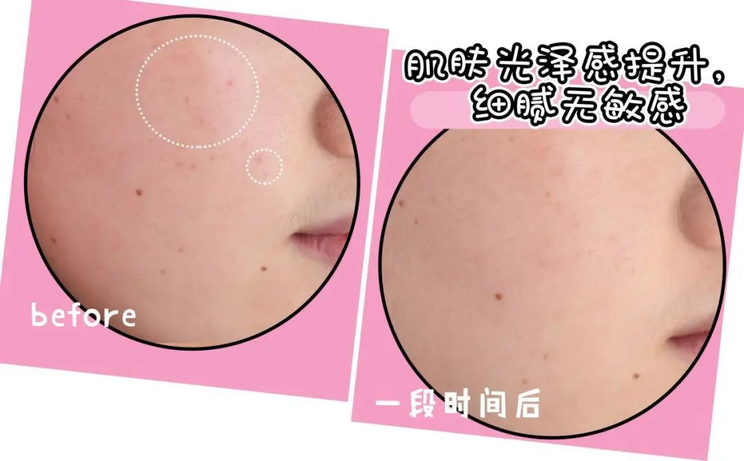 口罩戴出干燥、敏感、痘痘?来康康烂脸女孩都是怎么自救的!